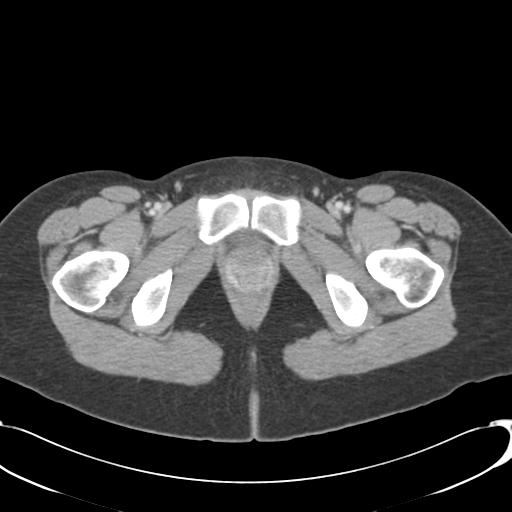 Appendicitis with minimal stranding but appendicolith (Radiopaedia 29035-29397 A 86).jpg