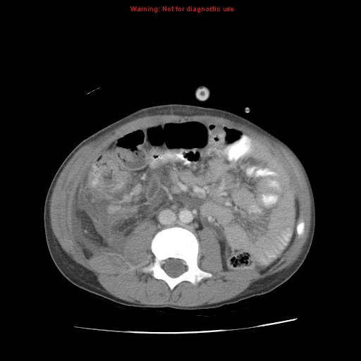 Appendicitis with phlegmon (Radiopaedia 9358-10046 A 39).jpg