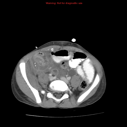 File:Appendicitis with phlegmon (Radiopaedia 9358-10046 A 50).jpg