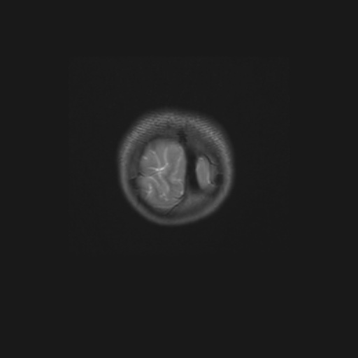Aqueduct stenosis (Radiopaedia 52453-58460 Coronal T2 2).jpg