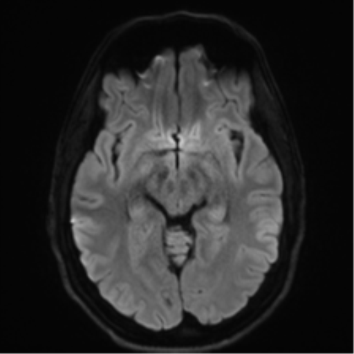 Arachnoid cyst - cerebellopontine angle (Radiopaedia 59689-67083 Axial DWI 52).png