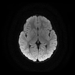 Arachnoid cyst - middle cranial fossa (Radiopaedia 86780-102938 Axial DWI 15).jpg