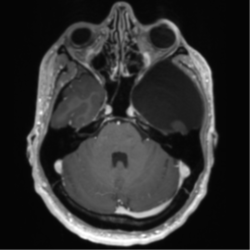 Arachnoid cyst with subdural hematoma (Radiopaedia 85892-101743 Axial T1 C+ 27).png
