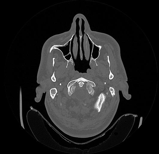 Arcuate foramen (Radiopaedia 89833-106944 Axial bone window 10).jpg