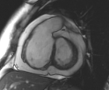 Arrhythmogenic right ventricular cardiomyopathy (Radiopaedia 69431-79307 Short axis cine 174).jpg