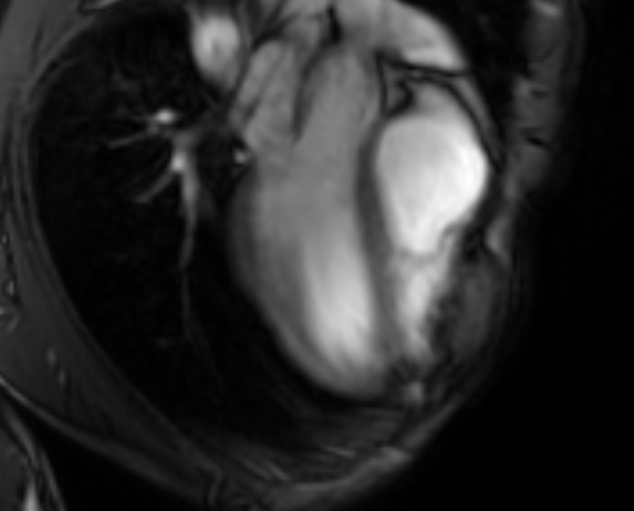 Arrhythmogenic right ventricular cardiomyopathy (Radiopaedia 69564-79464 4ch cine 24).jpg