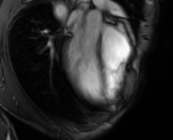 Arrhythmogenic right ventricular cardiomyopathy (Radiopaedia 69564-79464 4ch cine 32).jpg