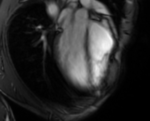 Arrhythmogenic right ventricular cardiomyopathy (Radiopaedia 69564-79464 4ch cine 33).jpg