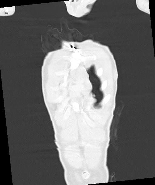 Arrow injury to the chest (Radiopaedia 85367-100975 Coronal lung window 40).jpg