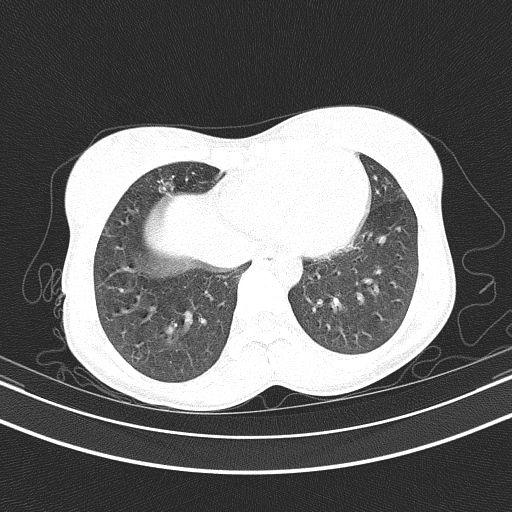 Arteria lusoria (Radiopaedia 88528-105192 Axial lung window 46).jpg