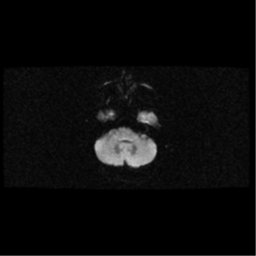 File:Arteriovenous malformation (cerebral) (Radiopaedia 40070-42580 Axial DWI 6).png