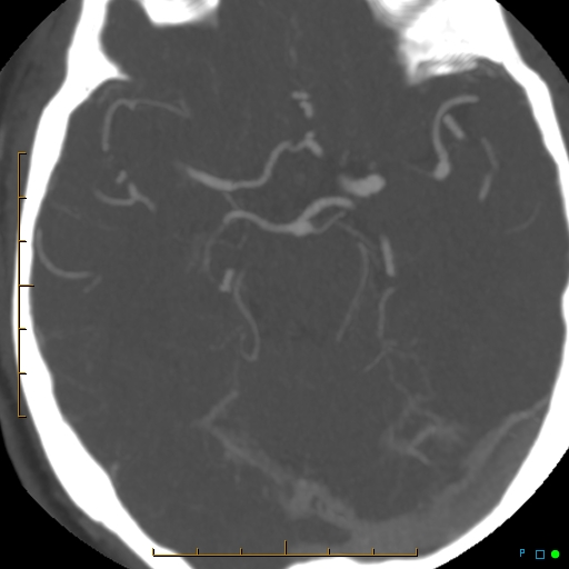 File:Artifactual basilar artery stenosis due to metallic stent (Radiopaedia 31206-31923 A 18).jpg
