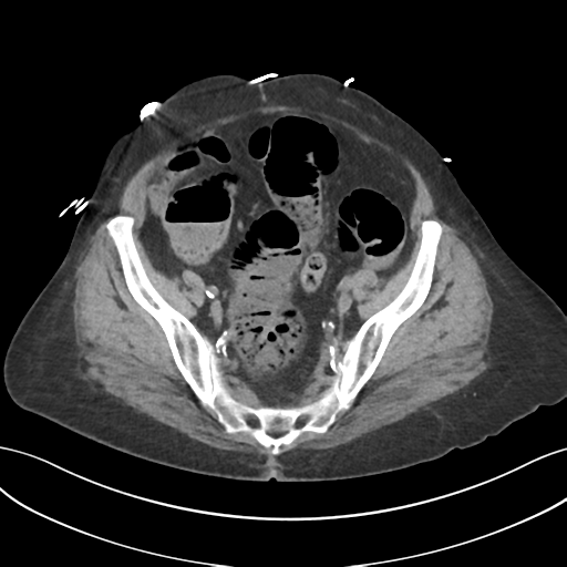 File:Ascending cholangitis (Radiopaedia 39068-41253 Axial non-contrast 52).png