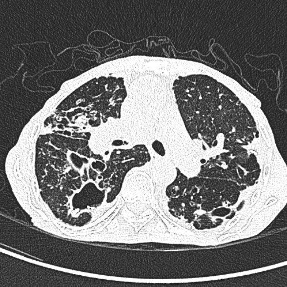 Aspergilloma- with Monod sign (Radiopaedia 44737-48532 Axial lung window 112).jpg