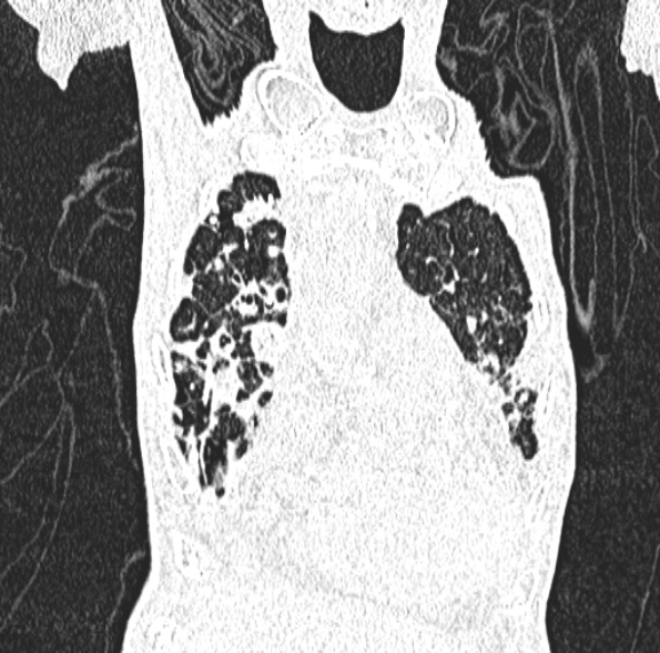 Aspergilloma- with Monod sign (Radiopaedia 44737-48532 Coronal lung window 151).jpg