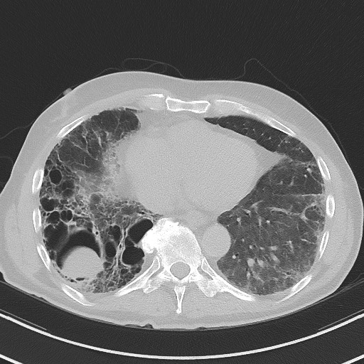 Aspergilloma on background pulmonary fibrosis (Radiopaedia 60942-68757 A 39).jpg