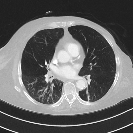 Aspiration bronchiolitis (Radiopaedia 53464-59463 Axial lung window 31).png