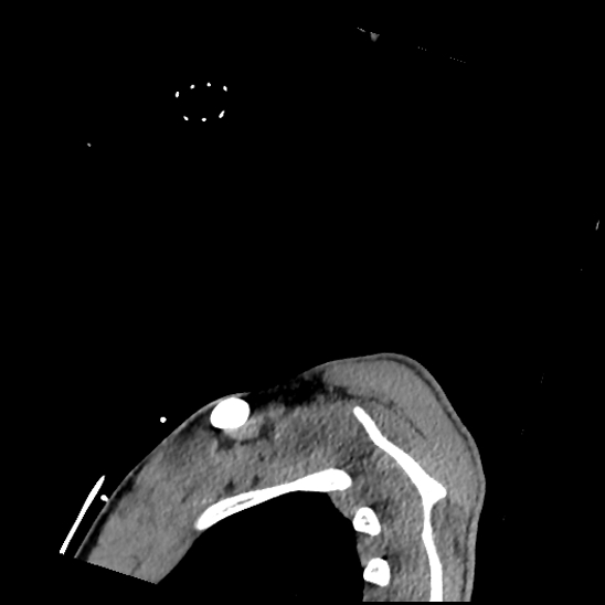Atlanto-occipital dissociation (Traynelis type 1), C2 teardrop fracture, C6-7 facet joint dislocation (Radiopaedia 87655-104061 D 87).jpg