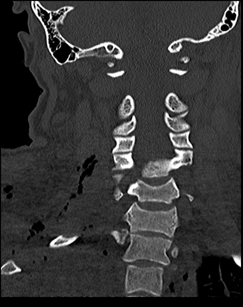 Atlanto-occipital dissociation - Traynelis type 1 (Radiopaedia 87570-103948 Coronal bone window 36).jpg