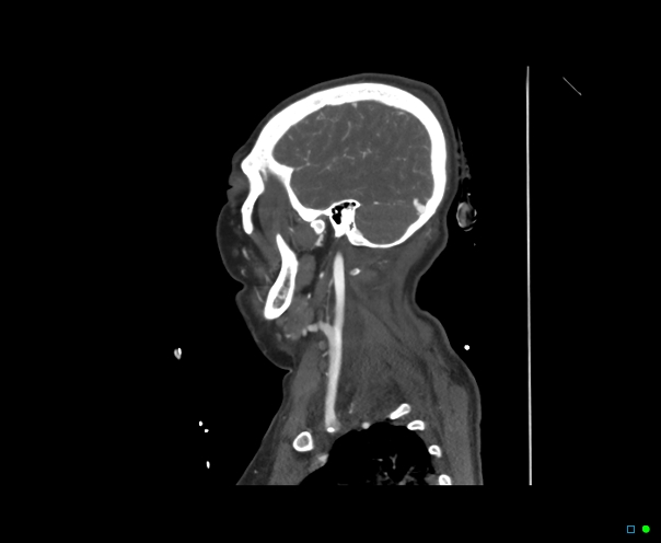 Atlanto-occipital dissociation - Traynelis type 1 (Radiopaedia 87570-103949 C 45).jpg
