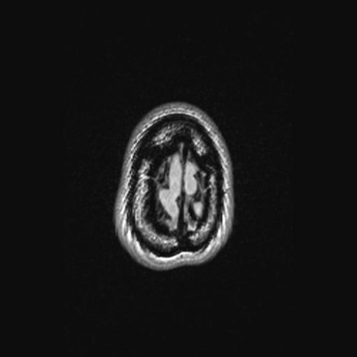 Atretic encephalocoele with inferior vermis hypoplasia (Radiopaedia 30443-31108 Axial 145).jpg