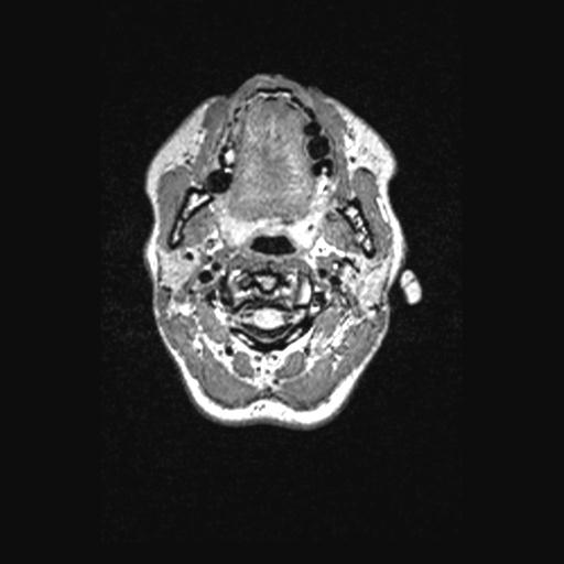 File:Atretic encephalocoele with inferior vermis hypoplasia (Radiopaedia 30443-31108 Axial 5).jpg