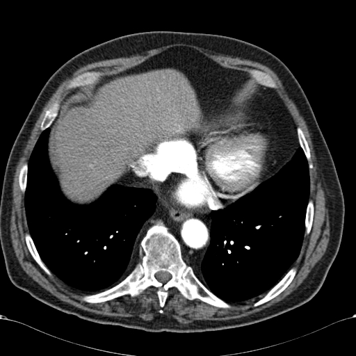 Atypical hepatocellular carcinoma (Radiopaedia 41744-44698 A 8).jpg