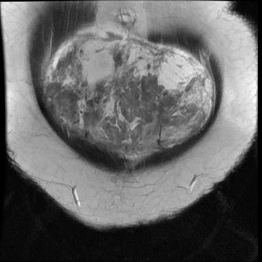 File:Atypical retroperitoneal lymphocoeles with large leiomyoma of uterus (Radiopaedia 32084-33027 Coronal T2 4).jpg