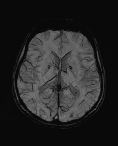 Autoimmune limbic encephalitis (Radiopaedia 30363-31005 SWI - mIP 39).jpg