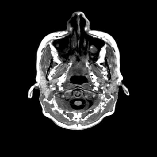 Autoimmune limbic encephalitis (Radiopaedia 30363-31005 T1 Axial 1mm 5).jpg