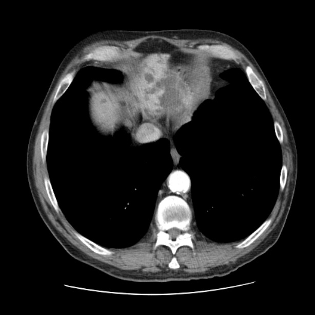 Autosomal dominant polycystic kidney disease (Radiopaedia 27851-28094 B 47).jpg