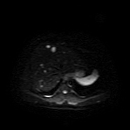 Autosomal dominant polycystic kidney disease (Radiopaedia 50259-55611 Axial DWI 7).jpg
