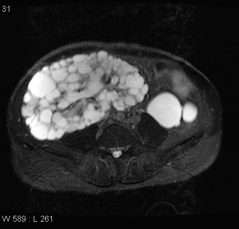 File:Autosomal dominant polycystic kidney disease (Radiopaedia 5202-6969 Axial T2 fat sat 13).jpg