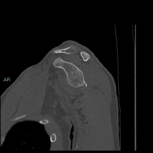 Avascular necrosis after fracture dislocations of the proximal humerus (Radiopaedia 88078-104655 Sagittal bone window 32).jpg