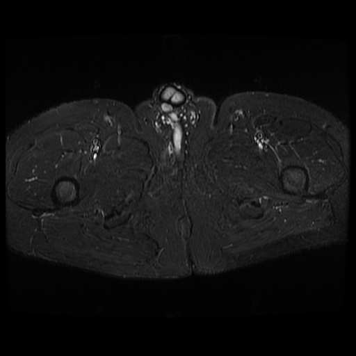 File:Avascular necrosis of the hip (Radiopaedia 61503-69465 Axial STIR 30).jpg