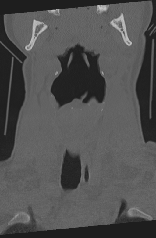 Axis peg fracture (type 3) and atlas lateral mass (type 4) fracture (Radiopaedia 37474-39324 Coronal bone window 2).png
