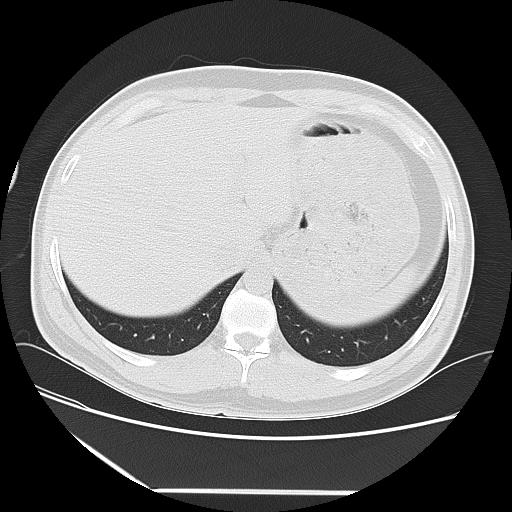 Azygos fissure (Radiopaedia 88181-104784 Axial lung window 50).jpg