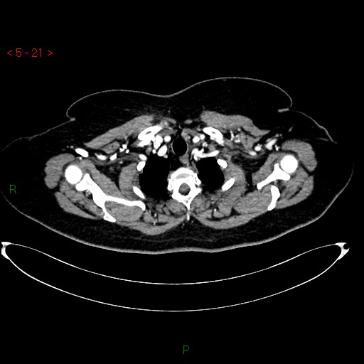 File:Azygos fissure and lobe (Radiopaedia 47620-52278 A 7).jpg
