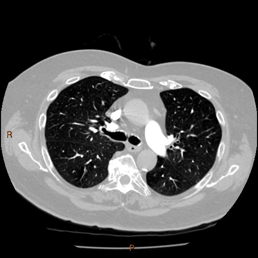 Azygos lobe (Radiopaedia 40161-42821 Axial lung window 26).jpg