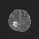 File:Balo concentric sclerosis (Radiopaedia 50458-55940 Axial DWI 30).jpg