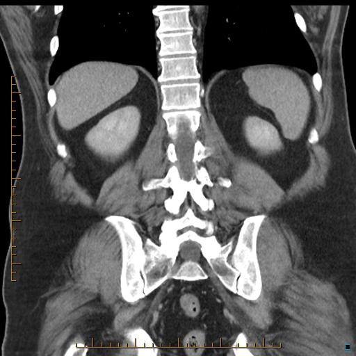 File:Bariatric balloon causing gastric outlet obstruction (Radiopaedia 54449-60672 B 45).jpg