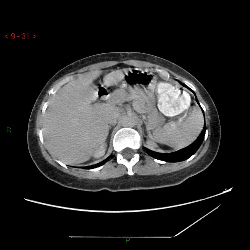 File:Bartholin gland cyst (Radiopaedia 54904-61181 Axial C+ delayed 8).jpg
