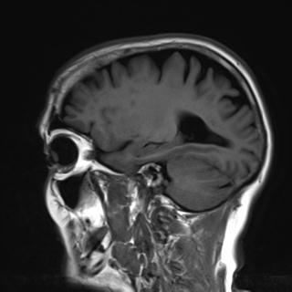 File:Base of skull chondrosarcoma (Radiopaedia 30410-31070 Sagittal T1 14).jpg