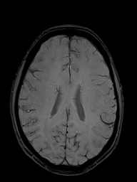 Basilar artery perforator aneurysm (Radiopaedia 82455-97733 Axial SWI 38).jpg