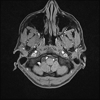 Basilar artery perforator aneurysm (Radiopaedia 82455-97733 Axial T1 fat sat 9).jpg
