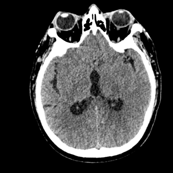 File:Basilar artery thrombosis (Radiopaedia 53351-59352 Axial non-contrast 62).jpg