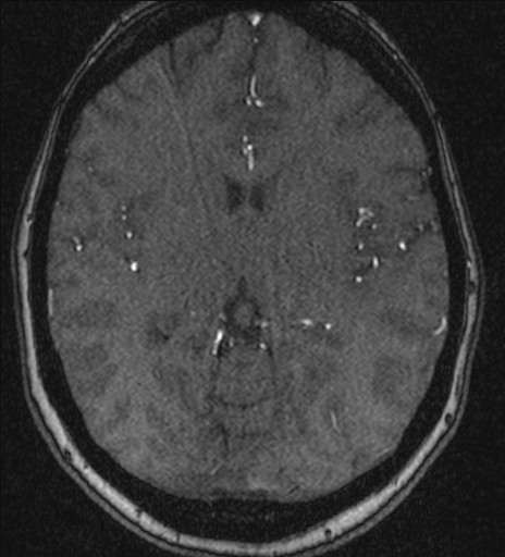 Basilar tip aneurysm (Radiopaedia 26504-26632 MRA 128).jpg