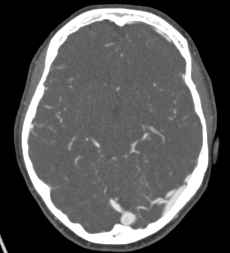 Basilar tip aneurysm with coiling (Radiopaedia 53912-60086 A 67).jpg
