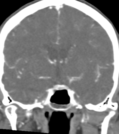 Basilar tip aneurysm with coiling (Radiopaedia 53912-60086 B 68).jpg