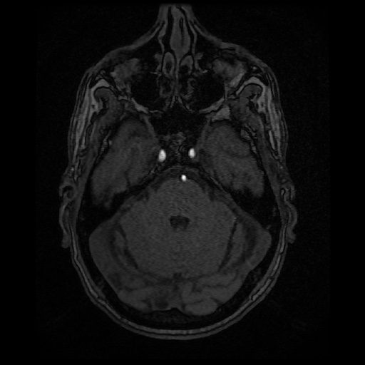 Basilar top and left middle cerebral artery aneurysm (Radiopaedia 61965-70031 Axial MRA 40).jpg